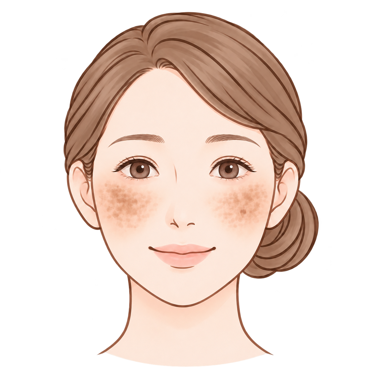 肝斑のイラスト